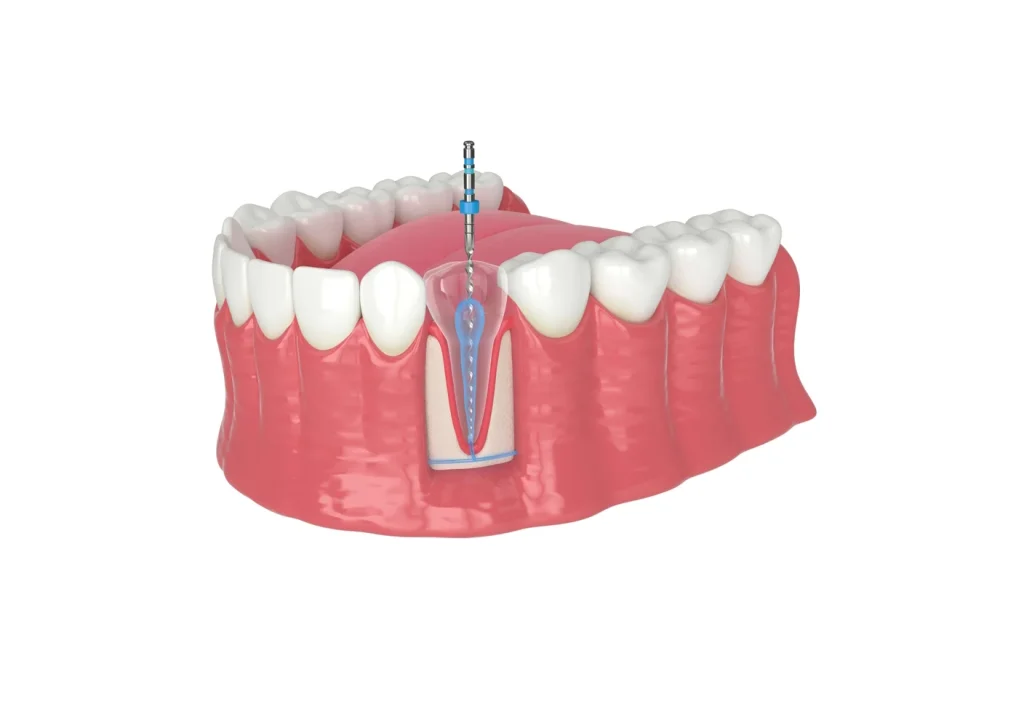 Root Canal Treatment